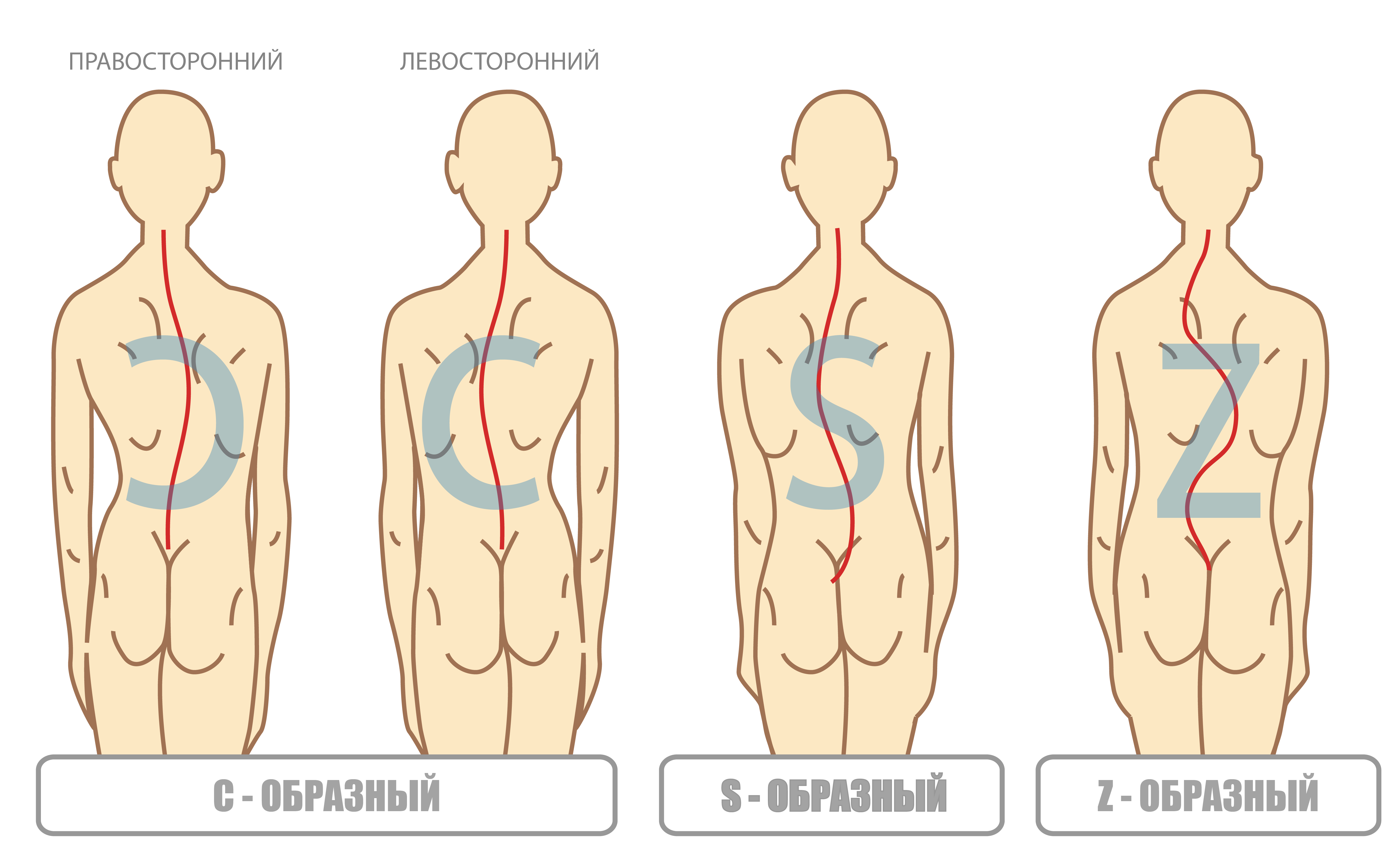 Сколиоз у детей: как предотвратить и можно ли вылечить? — МЦ Здоровые дети  Секреты долголетия